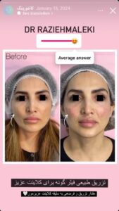 نمونه کار زاویه سازی صورت دکتر راضیه ملکی در ساری