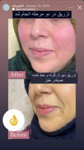 نمونه کار زاویه سازی صورت دکتر راضیه ملکی در ساری