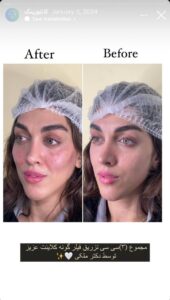 نمونه کار زاویه سازی صورت دکتر راضیه ملکی در ساری