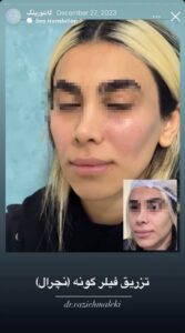 نمونه کار زاویه سازی صورت دکتر راضیه ملکی در ساری