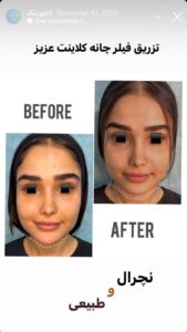 نمونه کار زاویه سازی صورت دکتر راضیه ملکی در ساری