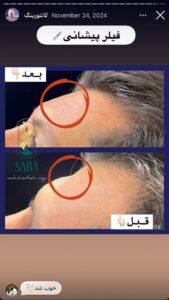 نمونه کار زاویه سازی صورت دکتر احتشامی در ساری