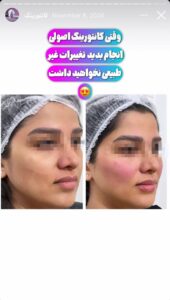 نمونه کار زاویه سازی صورت دکتر احتشامی در ساری