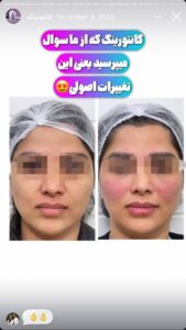 نمونه کار زاویه سازی صورت دکتر احتشامی در ساری