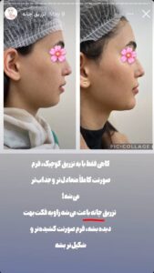 نمونه کار زاویه سازی صورت دکتر احتشامی در ساری