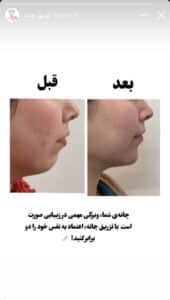 نمونه کار زاویه سازی صورت دکتر احتشامی در ساری