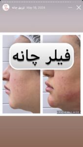 نمونه کار زاویه سازی صورت دکتر احتشامی در ساری