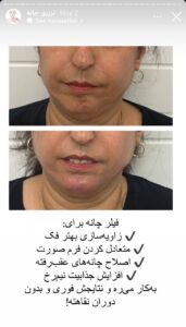 نمونه کار زاویه سازی صورت دکتر احتشامی در ساری