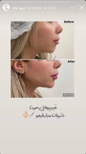 نمونه کار زاویه سازی صورت دکتر احتشامی در ساری