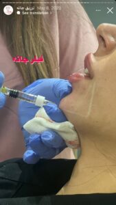 نمونه کار زاویه سازی صورت دکتر احتشامی در ساری