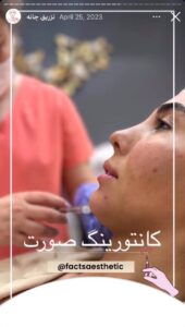 نمونه کار زاویه سازی صورت دکتر احتشامی در ساری