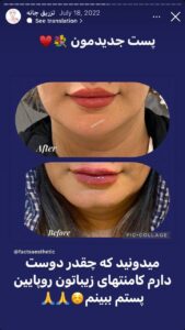 نمونه کار زاویه سازی صورت دکتر احتشامی در ساری