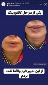 نمونه کار زاویه سازی صورت دکتر احتشامی در ساری