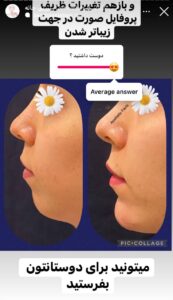 نمونه کار زاویه سازی صورت دکتر احتشامی در ساری