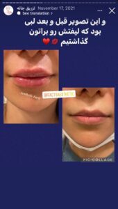 نمونه کار زاویه سازی صورت دکتر احتشامی در ساری