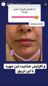 نمونه کار زاویه سازی صورت دکتر احتشامی در ساری