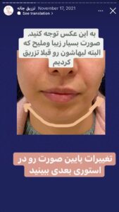 نمونه کار زاویه سازی صورت دکتر احتشامی در ساری