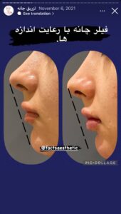 نمونه کار زاویه سازی صورت دکتر احتشامی در ساری