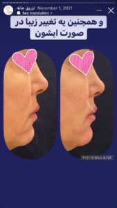 نمونه کار زاویه سازی صورت دکتر احتشامی در ساری