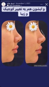 نمونه کار زاویه سازی صورت دکتر احتشامی در ساری