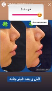 نمونه کار زاویه سازی صورت دکتر احتشامی در ساری