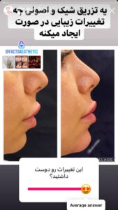 نمونه کار زاویه سازی صورت دکتر احتشامی در ساری