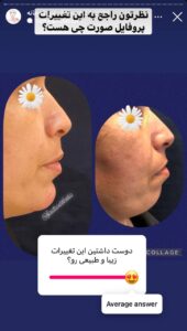 نمونه کار زاویه سازی صورت دکتر احتشامی در ساری