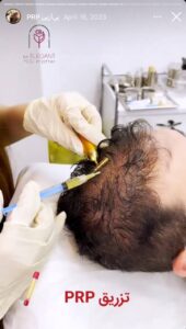 نمونه کار پی آر پی کلینیک الگانت در ساری