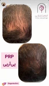 نمونه کار پی آر پی کلینیک الگانت در ساری