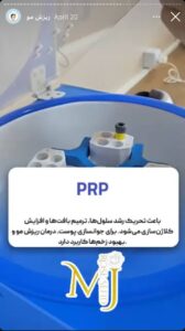 نمونه کار تزریق پی آر پی کلینیک رز سفید در ساری