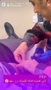 نمونه کار تزریق پی آر پی کلینیک رز سفید در ساری