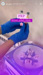 نمونه کار تزریق پی آر پی کلینیک رز سفید در ساری