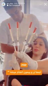 نمونه کار تزریق پی آر پی کلینیک رز سفید در ساری