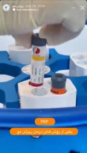 نمونه کار تزریق پی آر پی کلینیک رز سفید در ساری