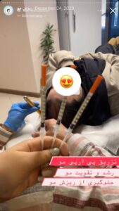 نمونه کار تزریق پی آر پی کلینیک رز سفید در ساری