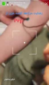 نمونه کار تزریق پی آر پی دکتر قلیان در ساری