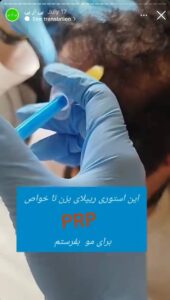 نمونه کار تزریق پی آر پی دکتر قلیان در ساری
