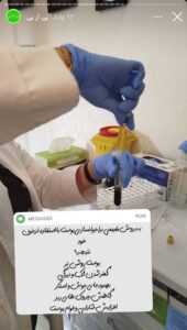 نمونه کار تزریق پی آر پی دکتر قلیان در ساری