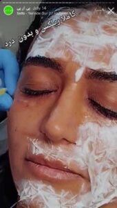 نمونه کار تزریق پی آر پی دکتر قلیان در ساری