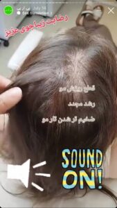 نمونه کار تزریق پی آر پی دکتر قلیان در ساری