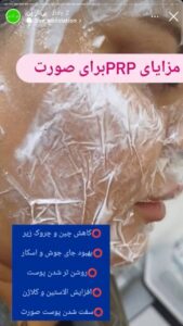 نمونه کار تزریق پی آر پی دکتر قلیان در ساری