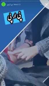 نمونه کار تزریق پی آر پی دکتر قلیان در ساری