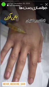 نمونه کار تزریق پی آر پی دکتر قلیان در ساری