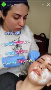 نمونه کار تزریق پی آر پی دکتر قلیان در ساری