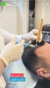 نمونه کار تزریق پی آر پی دکتر قلیان در ساری