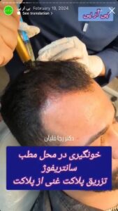 نمونه کار تزریق پی آر پی دکتر قلیان در ساری