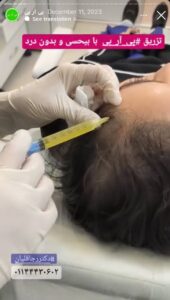 نمونه کار تزریق پی آر پی دکتر قلیان در ساری