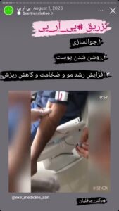 نمونه کار تزریق پی آر پی دکتر قلیان در ساری