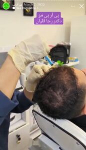نمونه کار تزریق پی آر پی دکتر قلیان در ساری