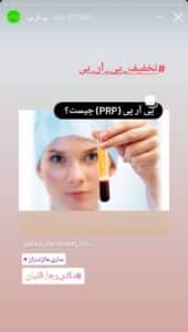 نمونه کار تزریق پی آر پی دکتر قلیان در ساری